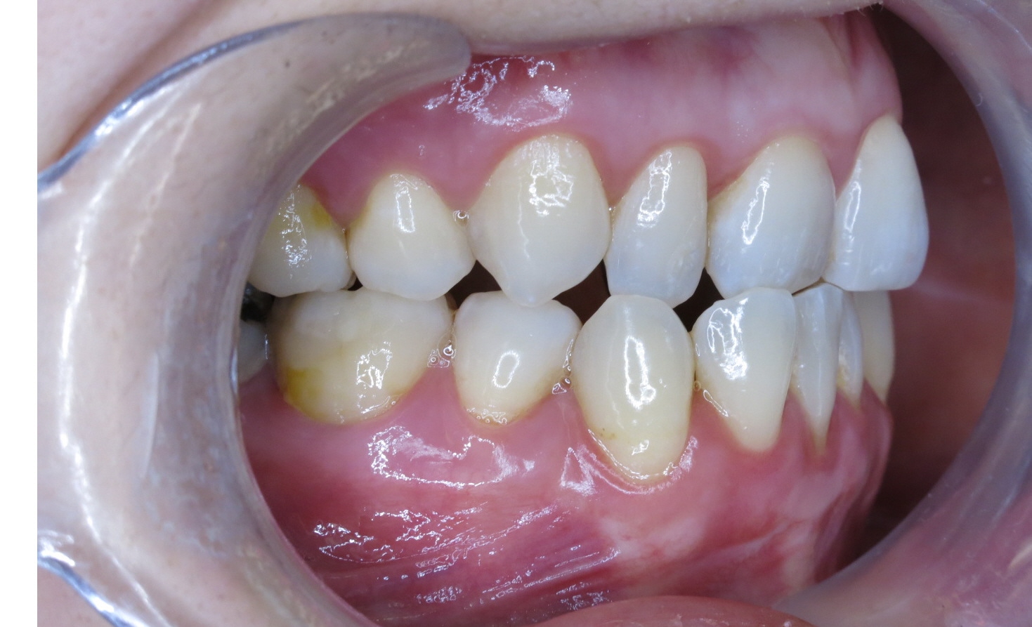 Clear Aligners Oakridge Orthodontics Vancouver BC